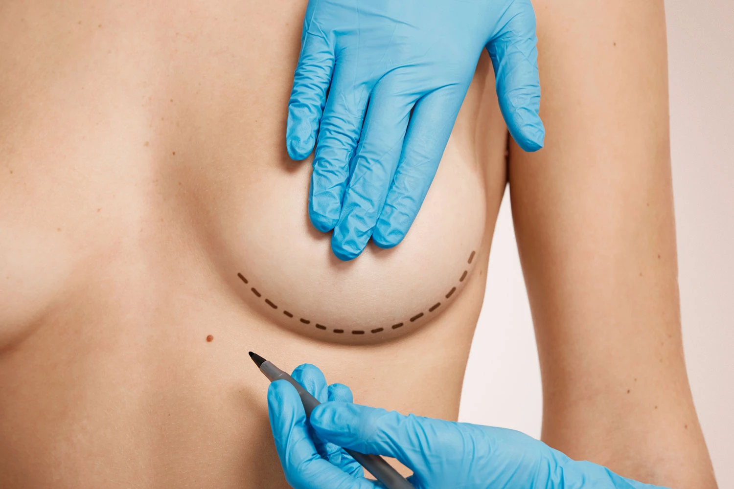 A Complete Guide to Breast Augmentation Surgery image