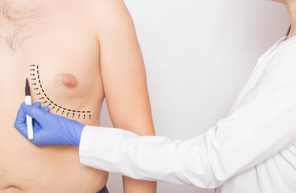 Overcoming Male Breast Enlargement: Gynecomastia Surgery image