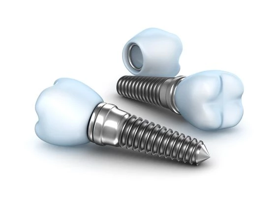 Immediate Dental Implants image