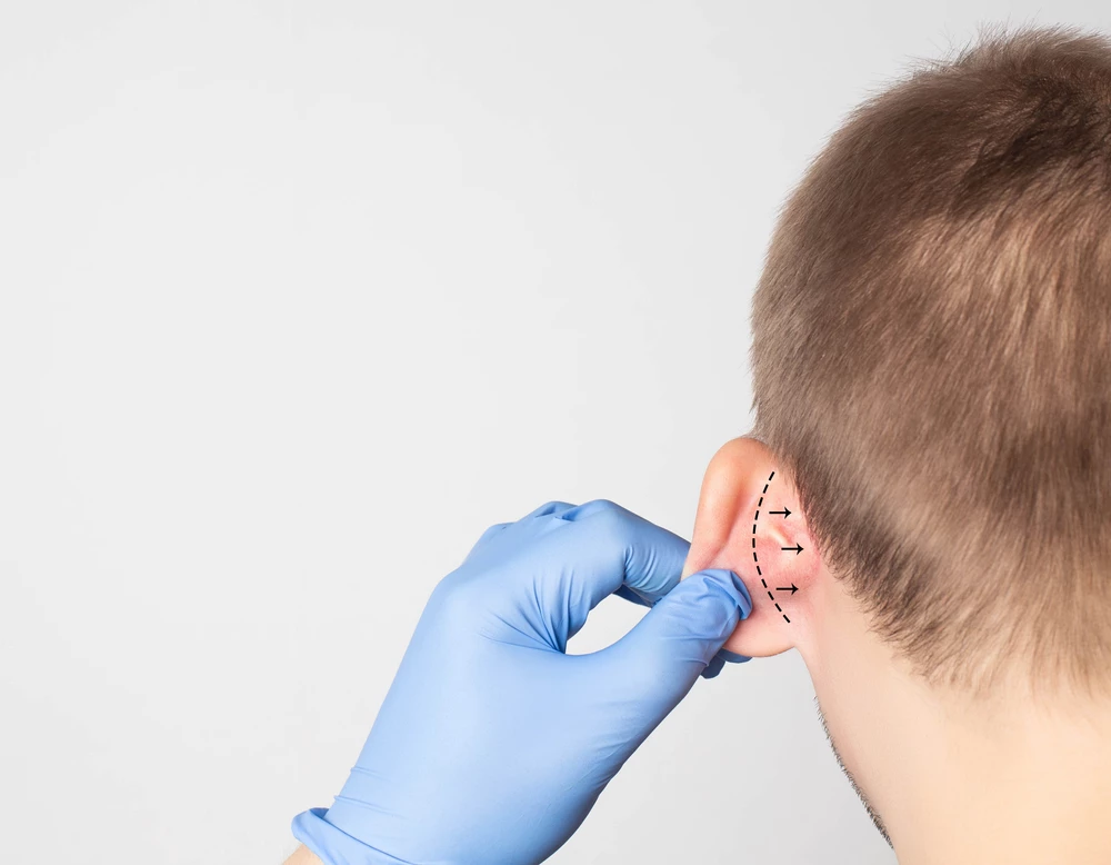 Reshaping Your Ear Aesthetics: A Guide to Otoplasty Surgery image