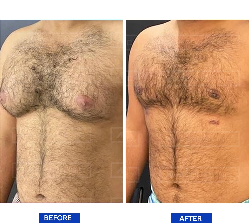 Overcoming Male Breast Enlargement Gynecomastia Surgery