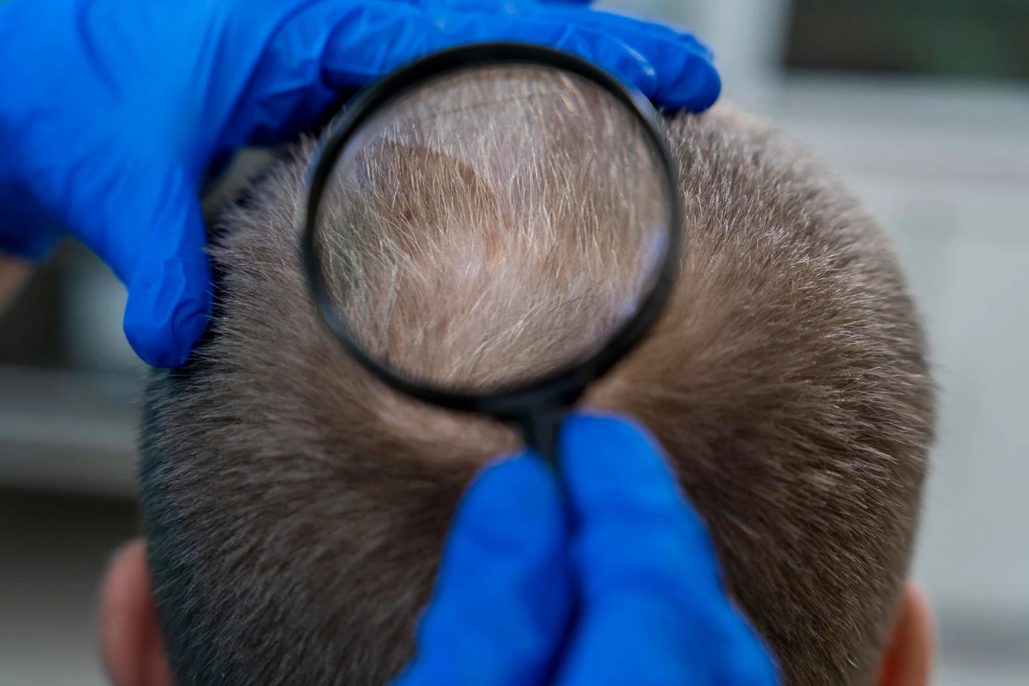 Direct Hair Implantation (DHI) Transplant